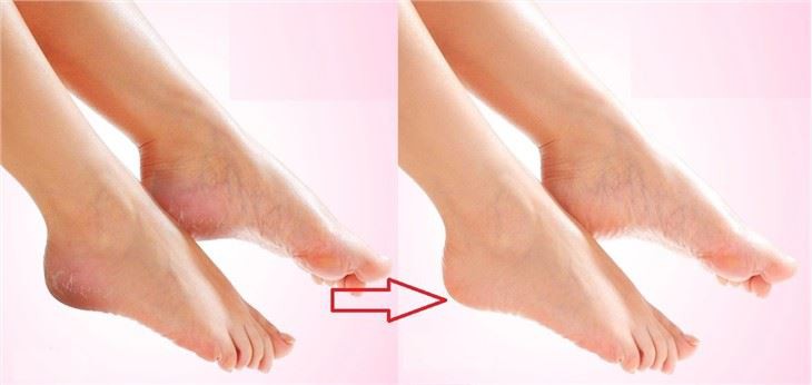 feet peeling mask